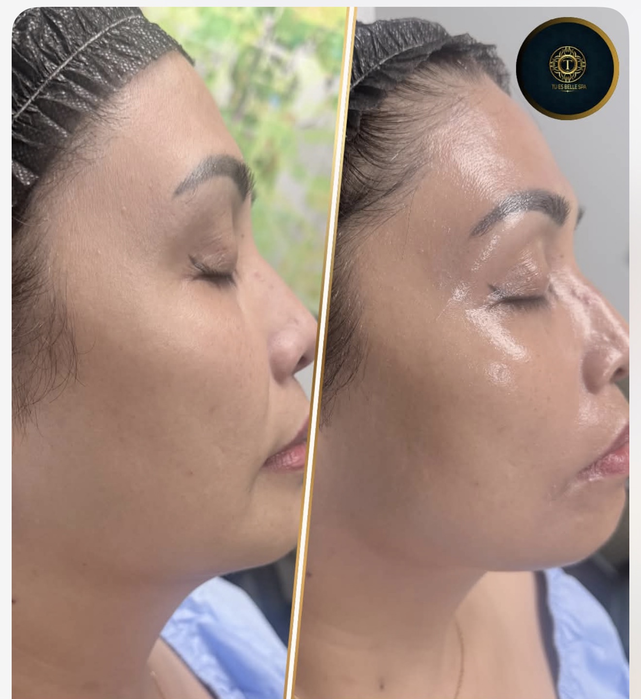 BBGlow Facial before and right after one session at Tu Es Belle Spa Houston