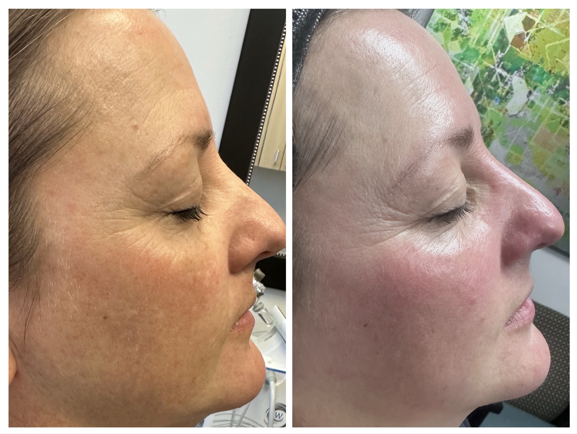 Before and after facial transformation 4 sessions at Tu Es Belle Spa Houston