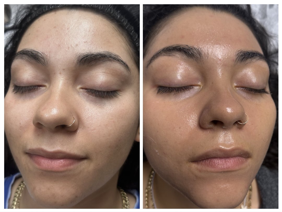 Before and after chemical peel oxygen bubbles facial microneedling and carbon laser facial at Tu Es Belle Spa Houston