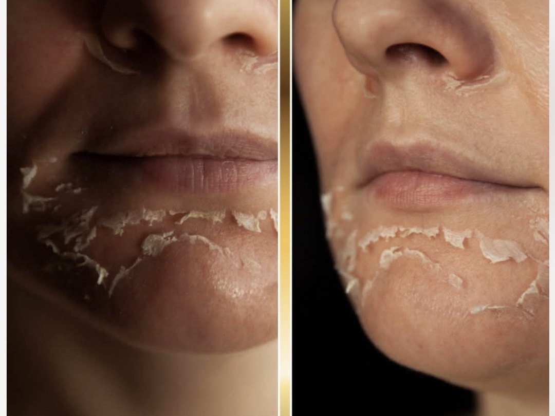 Chemical peel skin shedding during peel recovery at Tu Es Belle Spa Houston