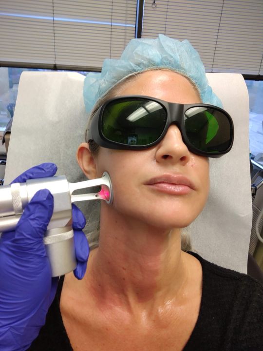 Skin Resurfacing CO2 at Tu Es Belle Spa Houston