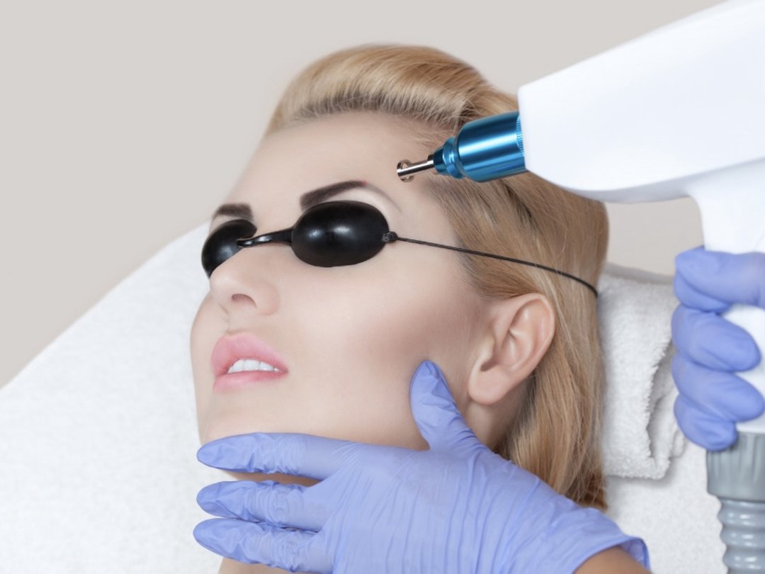 Eyebrow laser tattoo removal of microbladed brows at Tu Es Belle Spa Houston