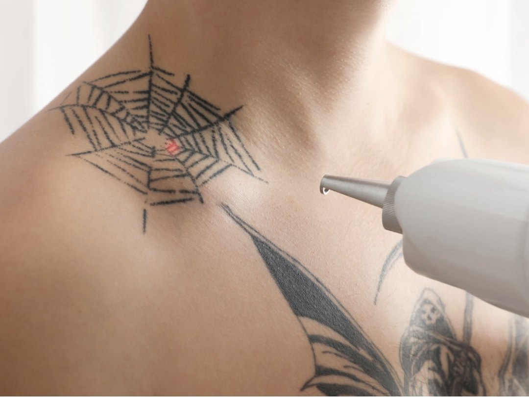Laser tattoo removal at Tu Es Belle Spa Houston