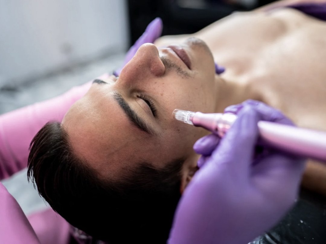 Microneedling with PDRN and exosome therapy at Tu Es Belle Spa Houston