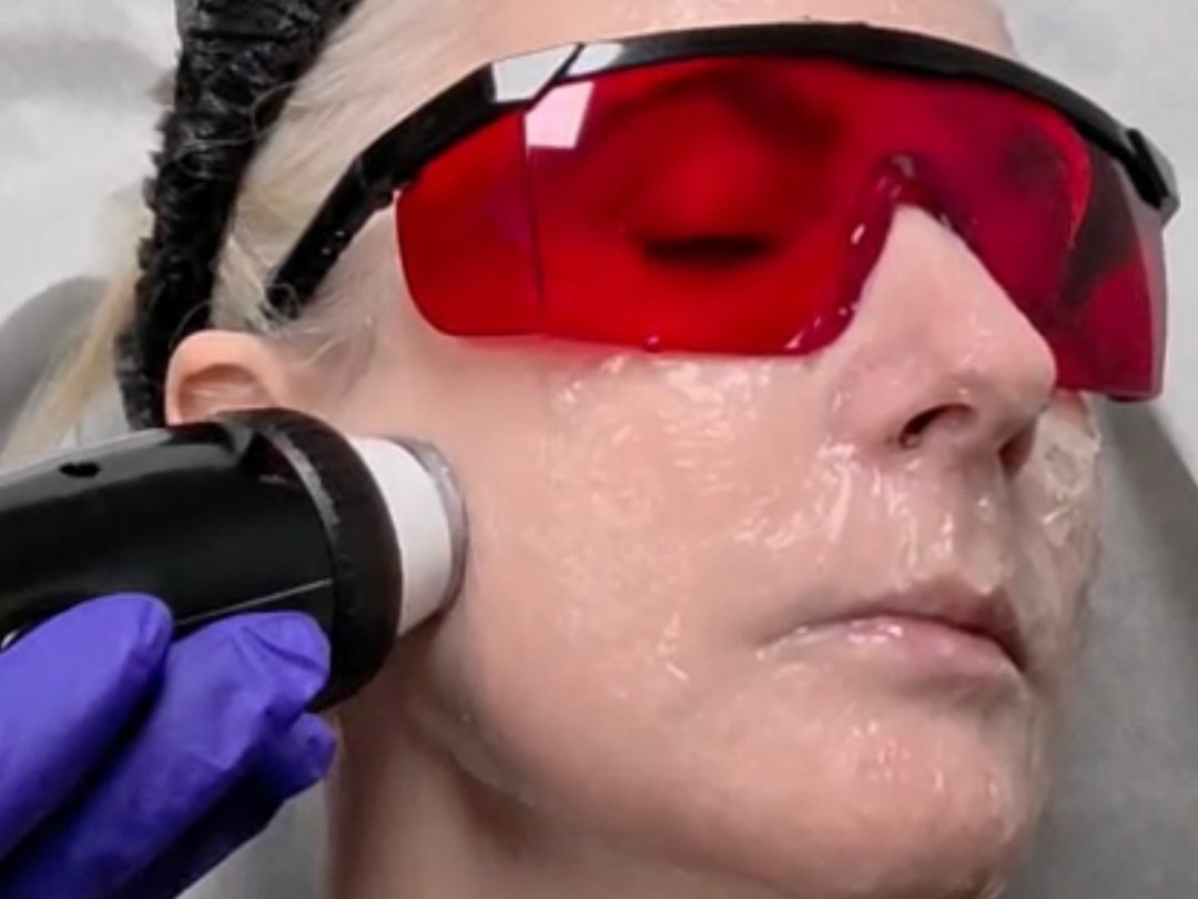 Radio frequency facial treatment with hydra mask at Tu Es Belle Spa Houston