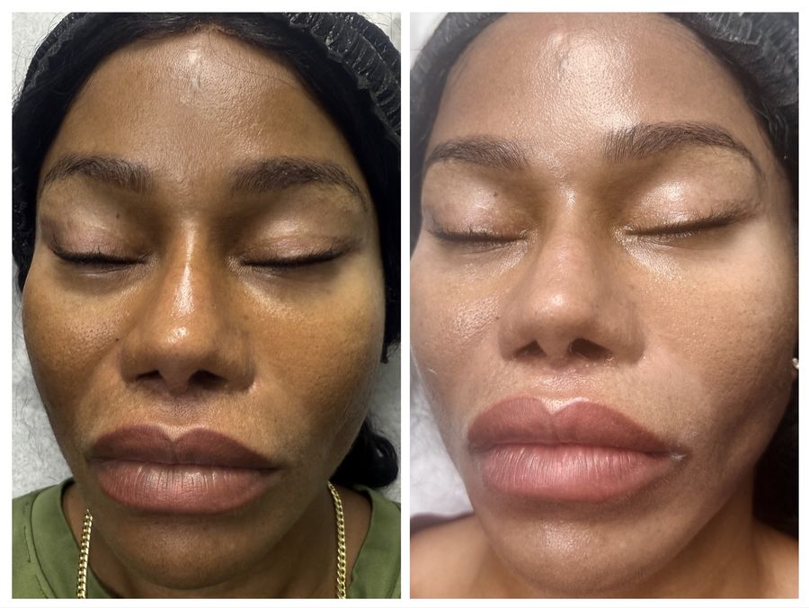 Before and after 3 sessions of Carbon Laser Facial, microneedling with hyaluronic acid and chemical peel at Tu Es Belle Spa in Houston Texas