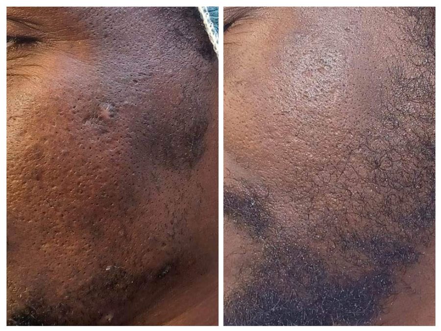 Before and after 3 sessions of CO2 skin resurfacing, microneedling with PDRN and gold leaf facial with gua sha at Tu Es Belle Spa in Houston Texas
