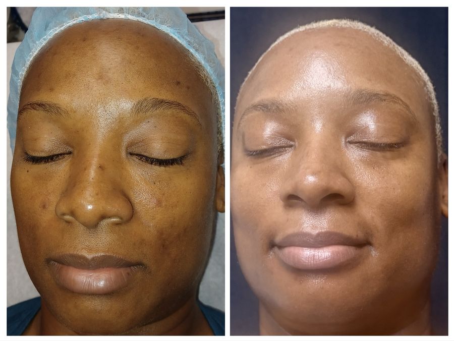 Before and after 4 sessions of chemical peel, microneedling with hyaluronic acid, radio frequency with LED light therapy and high frequency with hot stones at Tu Es Belle Spa in Houston Texas