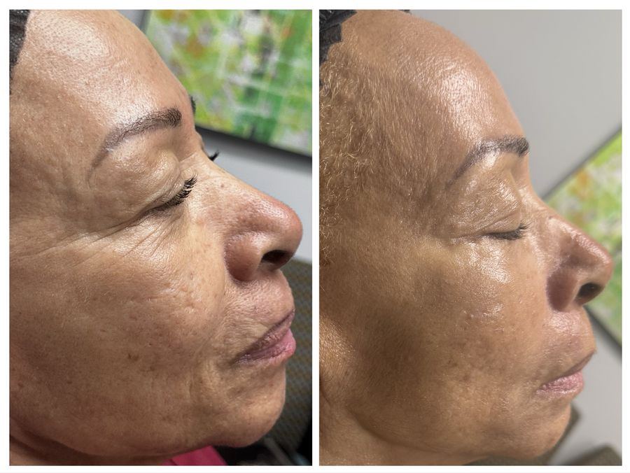 Before and after 4 sessions of chemical peel, microneedling with hyaluronic acid, CO2 skin resurfacing and carbon laser facial with gua sha at Tu Es Belle Spa in Houston Texas