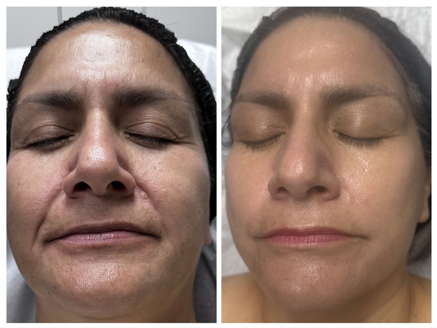 Before and after 4 sessions of chemical peel, microneedling with PDRN and CO2 skin resurfacing at Tu Es Belle Spa in Houston Texas