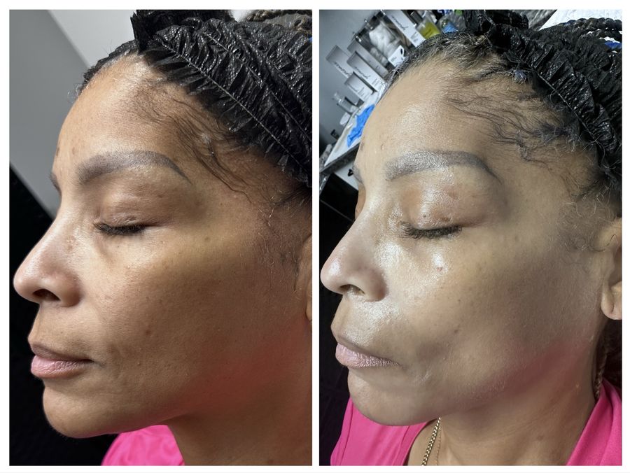 Before and right after an oxygen bubble facial at Tu Es Belle Spa in Houston Texas