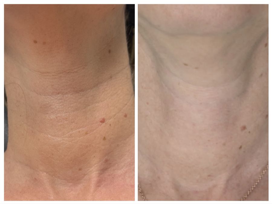 Neck only before and after 3 sessions of chemical peel, microneedling with PDRN and CO2 skin resurfacing at Tu Es Belle Spa in Houston Texas