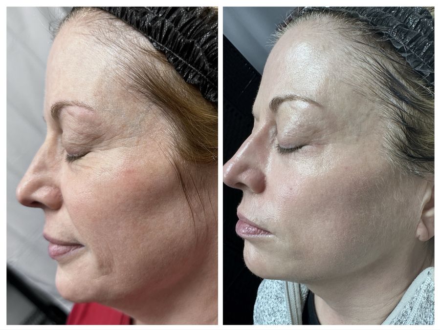 Before and after 4 sessions of chemical peel, microneedling with PDRN, CO2 skin resurfacing and gold leaf facial with LED light therapy at Tu Es Belle Spa in Houston Texas