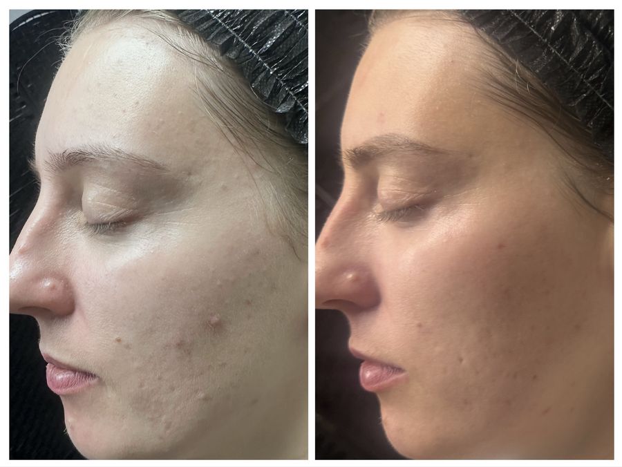 Before and after 4 sessions of chemical peel, microneedling with PDRN, CO2 skin resurfacing and IPL photofacial at Tu Es Belle Spa in Houston Texas