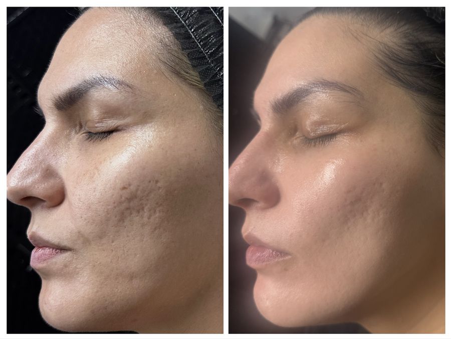 Before and after 4 sessions of chemical peel, microneedling with PDRN, TCA CROSS chemical peel and radio frequency facial at Tu Es Belle Spa in Houston Texas