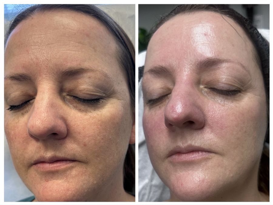 Before and after 4 sessions of chemical peel, microneedling with peptides, CO2 skin resurfacing and hydrafacial with gua sha at Tu Es Belle Spa in Houston Texas