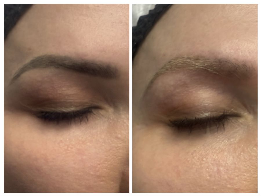 Eyebrow laser tattoo removal before and after one session at Tu Es Belle Spa in Houston Texas
