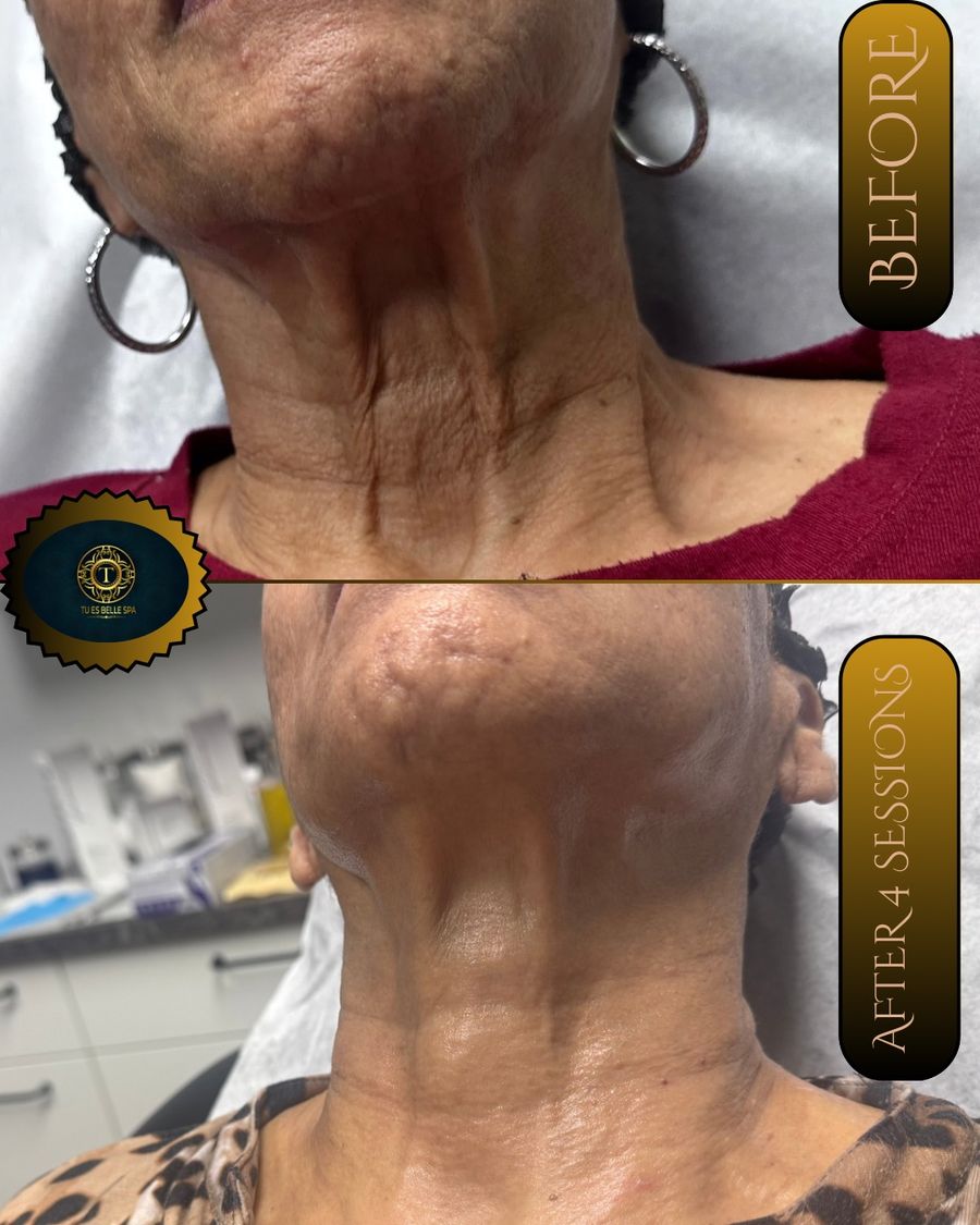 Neck before and after 4 sessions of chemical peel, microneedling with peptides, CO2 skin resurfacing and carbon laser facial with hydra mask at Tu Es Belle Spa in Houston Texas