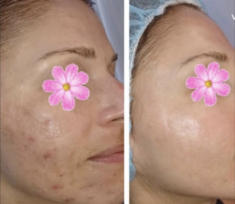 Before and after microneedling with hyaluronic acid, chemical peel, Epionce Lux Facial and CO2 skin resurfacing at Tu Es Belle Spa in Houston Texas