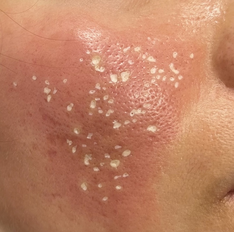 TCA CROSS chemical peel at Tu Es Belle Spa Houston